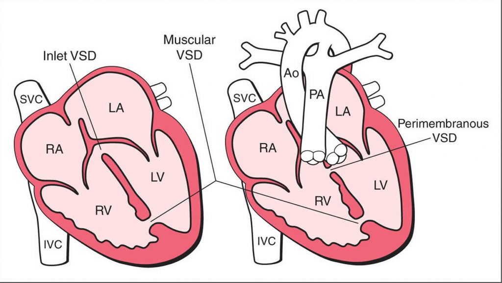 What is Congenital Heart Disease - Types, Causes, and Symptoms