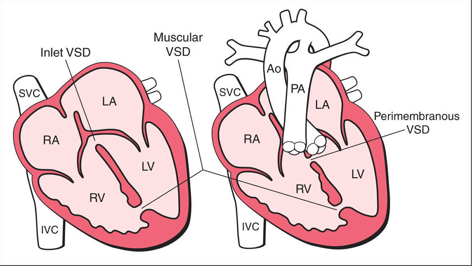 What is Congenital Heart Disease Types, Causes, and Symptoms