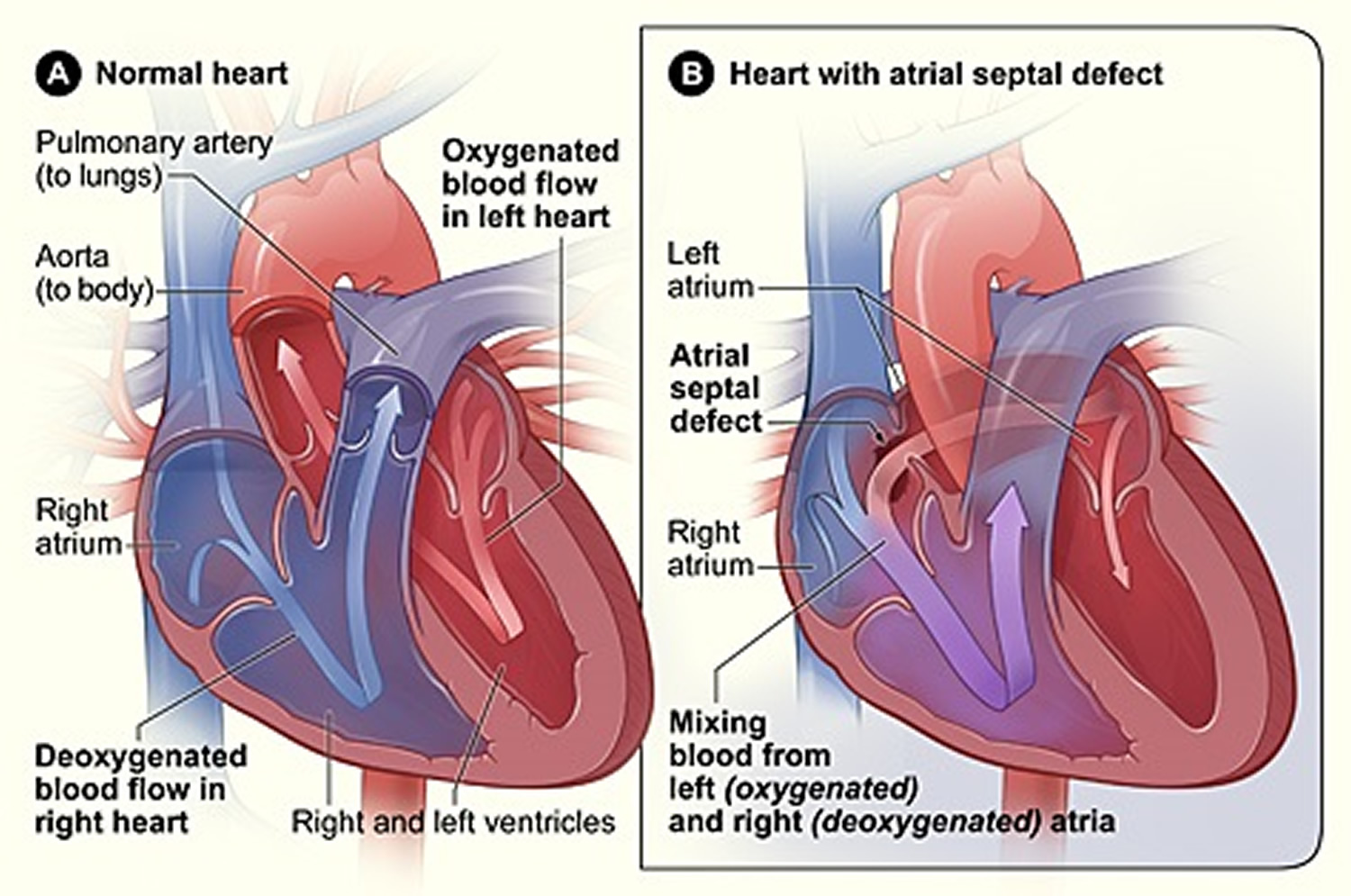 What Is Congenital Heart Disease Types Causes And Symptoms 8691