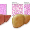 fatty liver