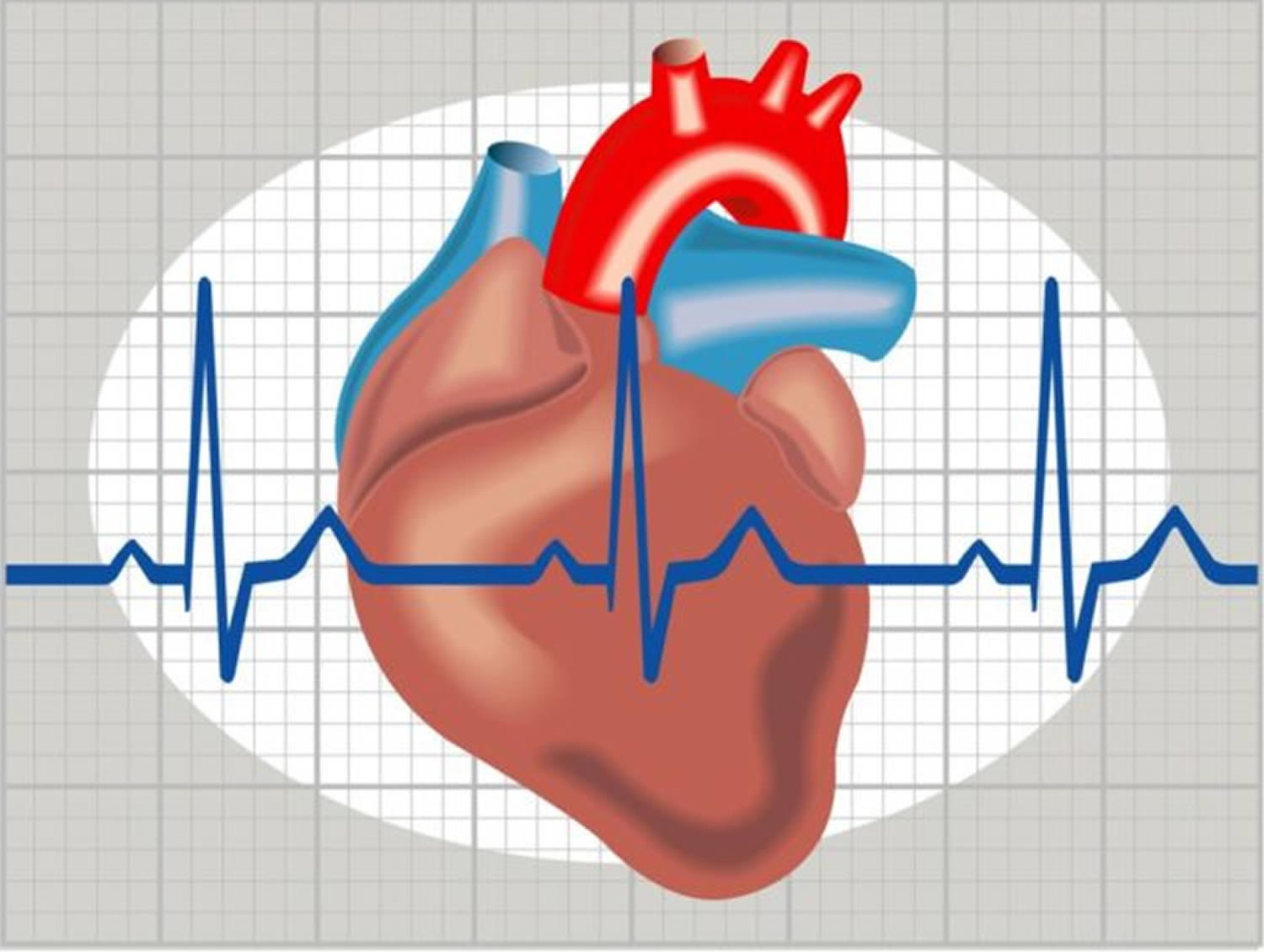 arrhythmia symptoms