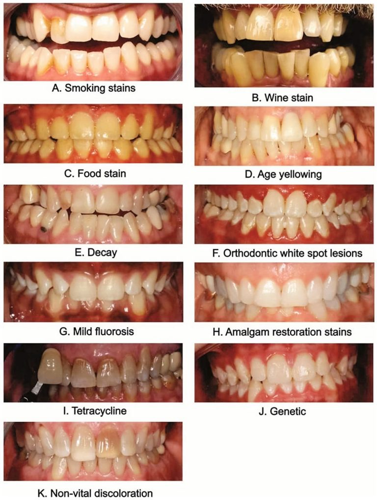 How to Whiten Teeth Naturally - Home Treatment Vs Professional Therapy