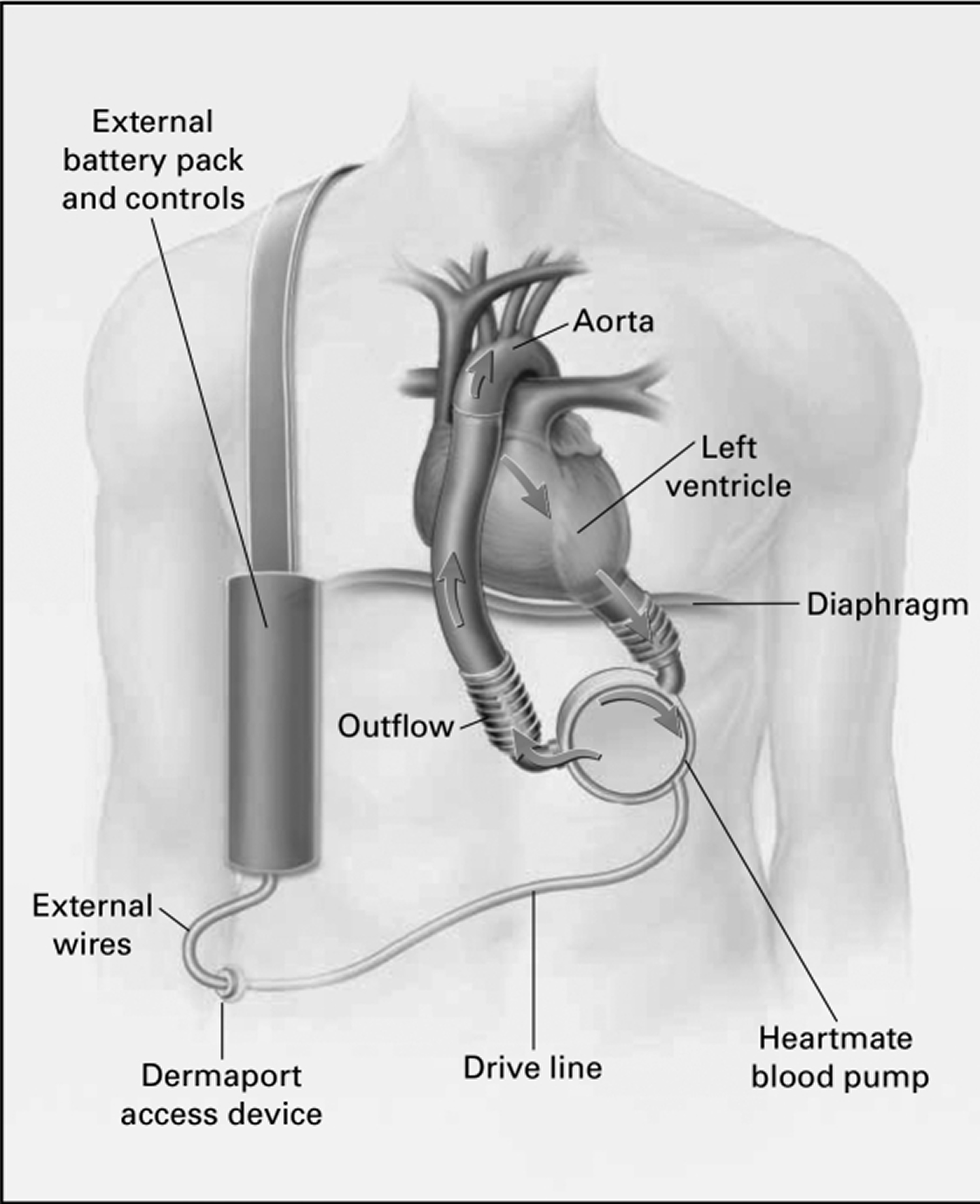 enlarged-heart-causes-signs-symptoms-treatment