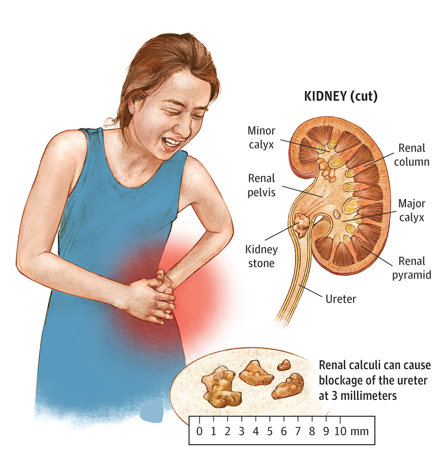 kidney stone pain chart