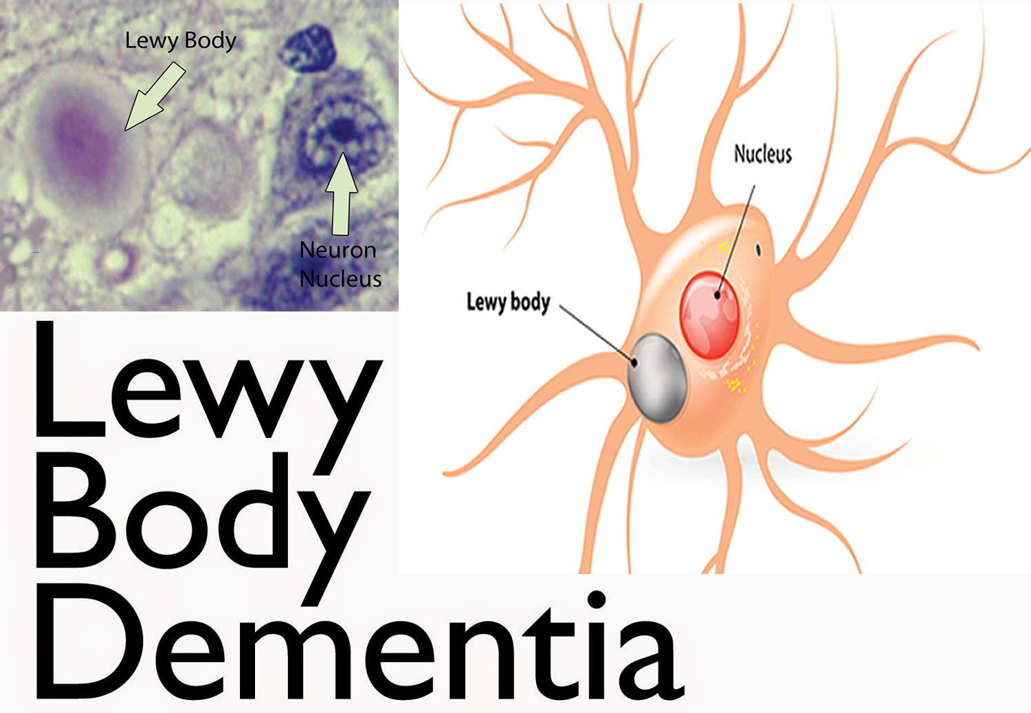 What Lewy Body Dementia - Diagnosis, Treatments
