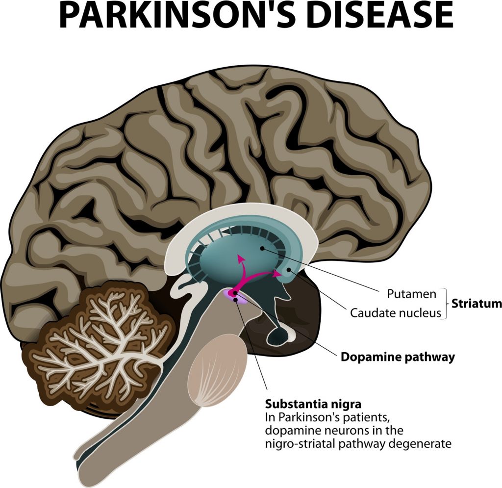 What is Parkinson's Disease Causes, Signs, Symptoms and Treatments