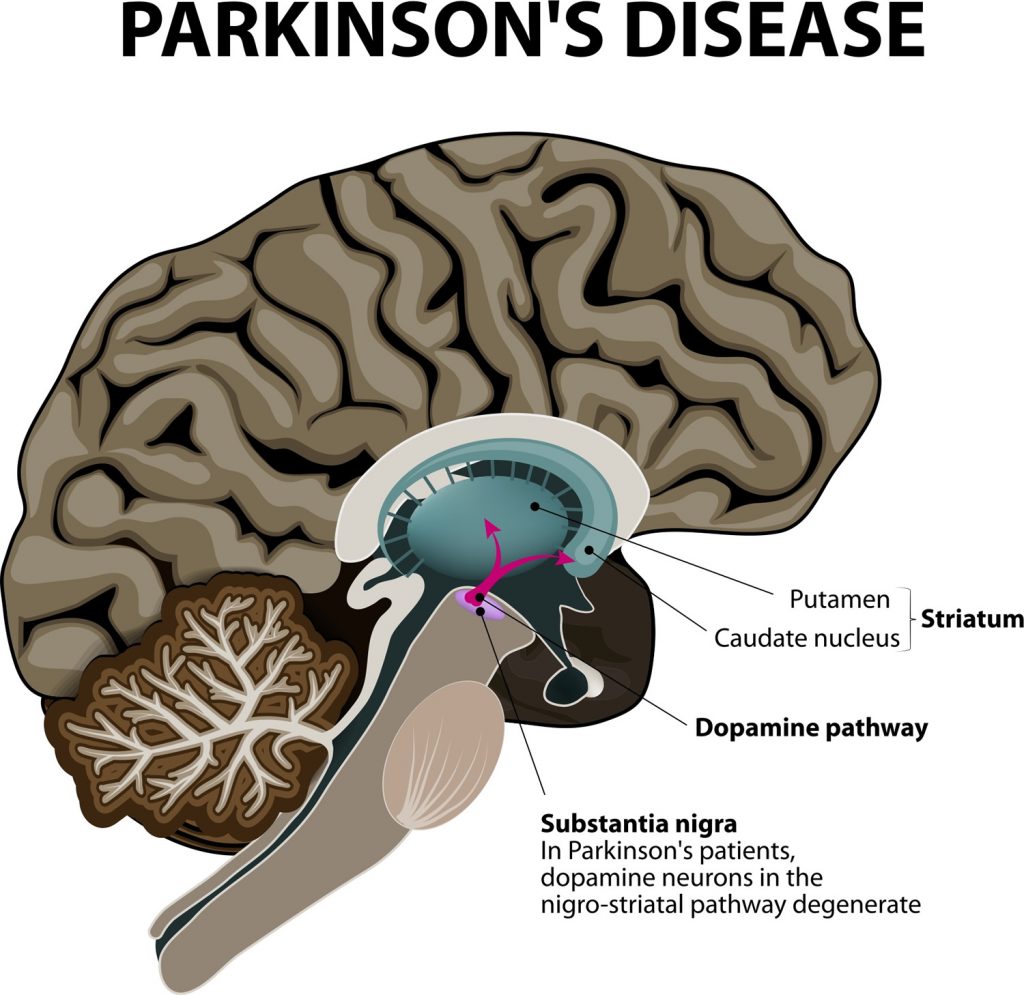 what-is-parkinson-s-disease-causes-signs-symptoms-and-treatments