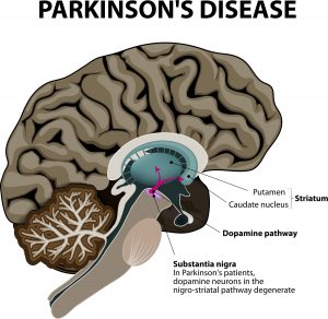 What is Parkinson's Disease - Causes, Signs, Symptoms and Treatments