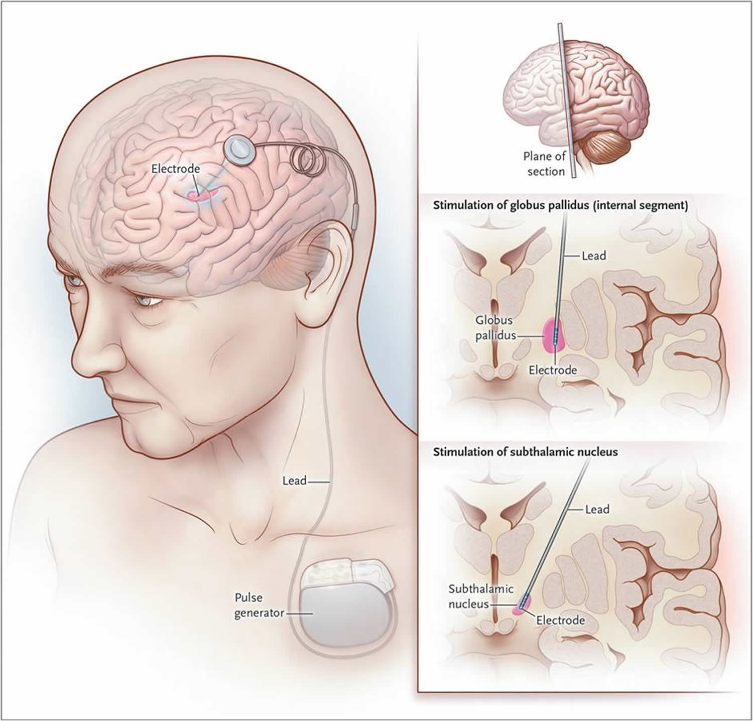 deep brain stimulator