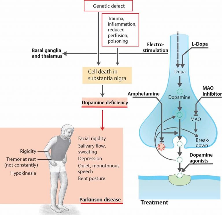 What is Parkinson's Disease - Causes, Signs, Symptoms and Treatments