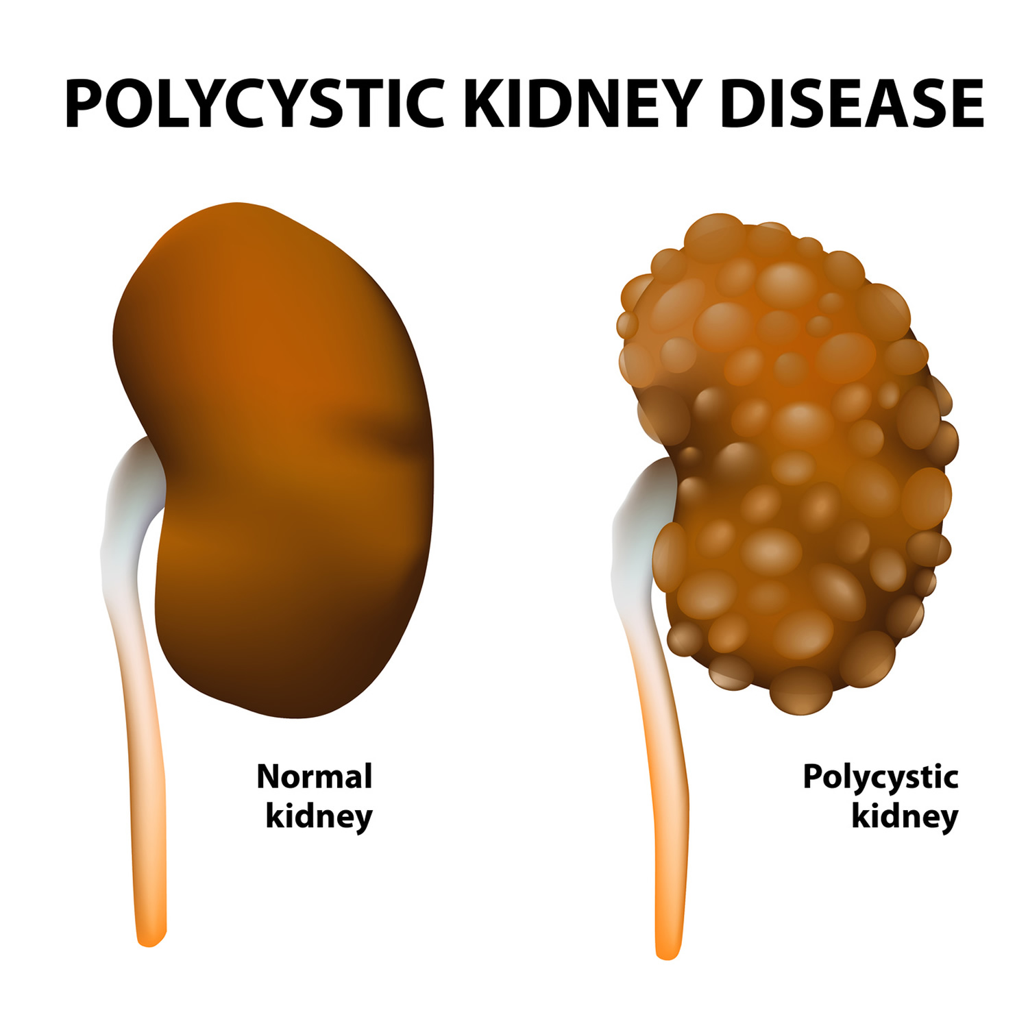 polycystic kidney disease