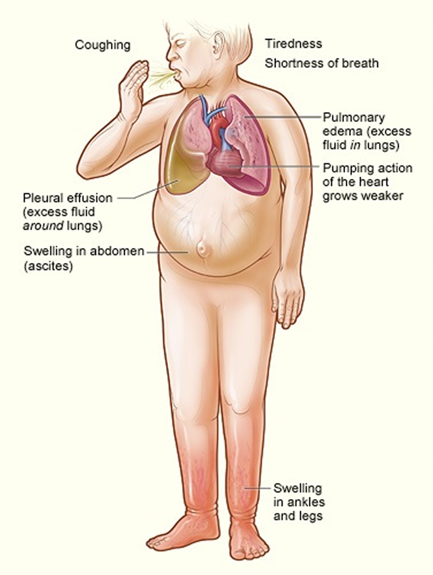 heart-failure-pathophysiology-via-medcomic-heart-failure-nursing