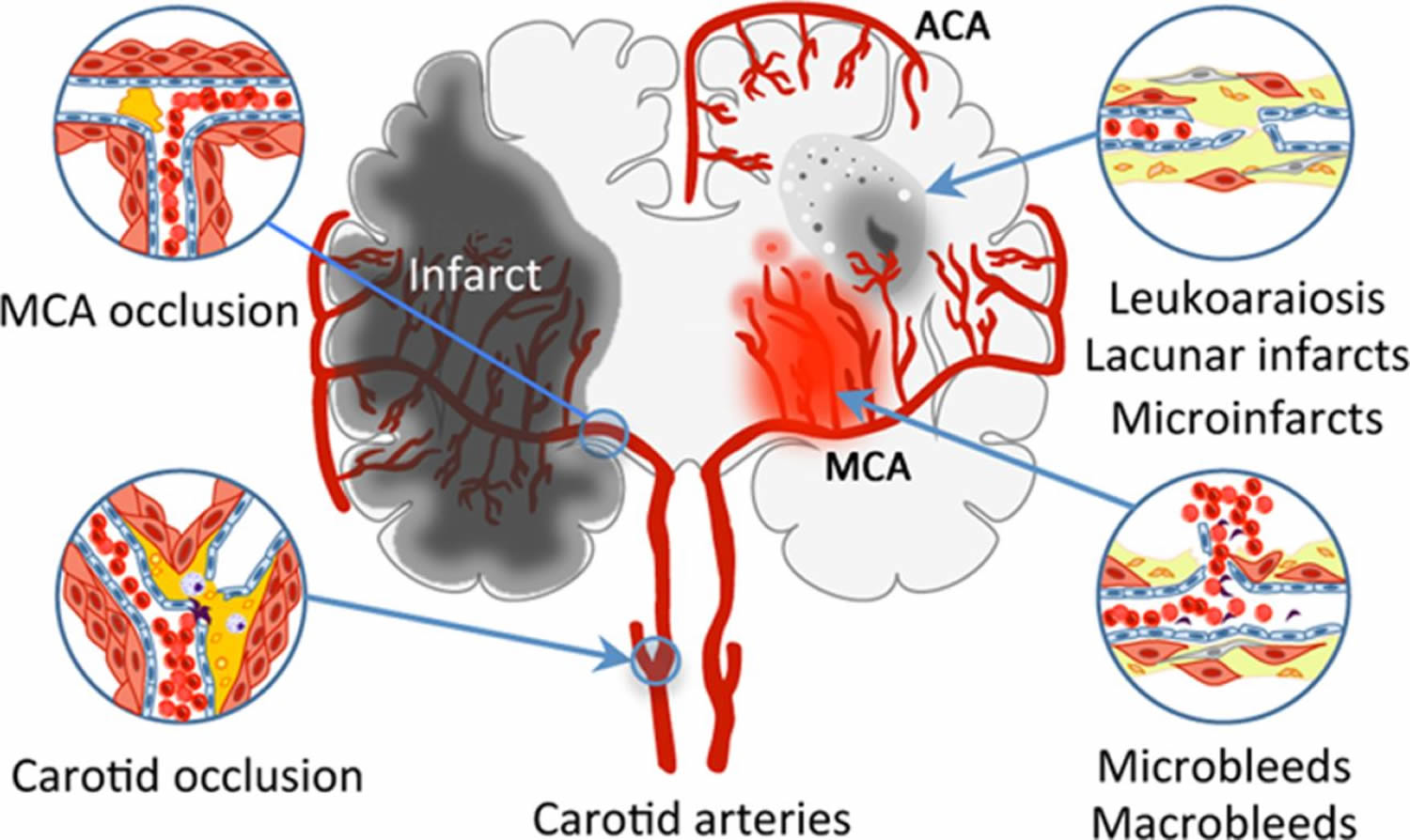 What Is The Correct Code For Vascular Dementia Without Behavioral Disturbance