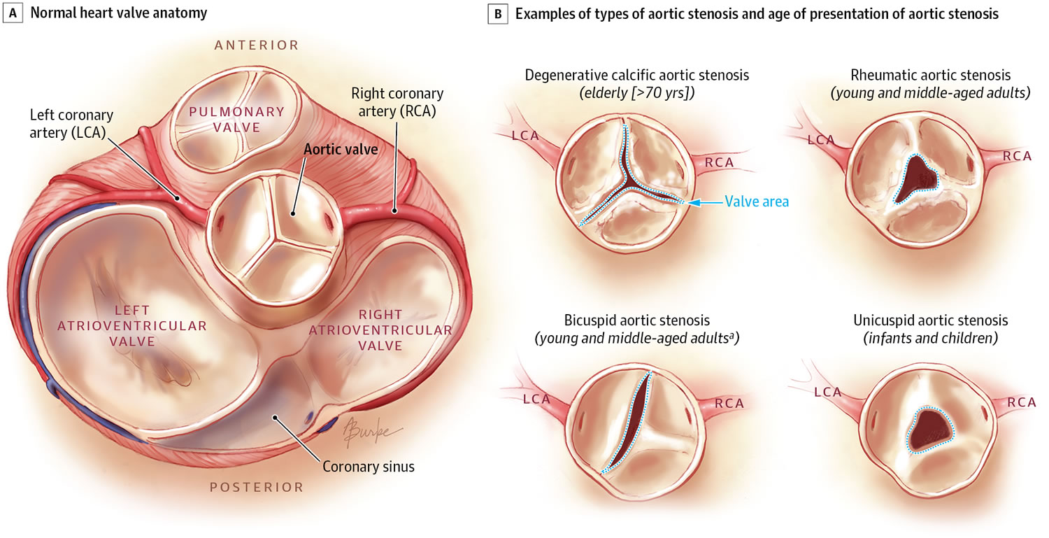 facts-about-aortic-stenosis-dr-peter-mikhail