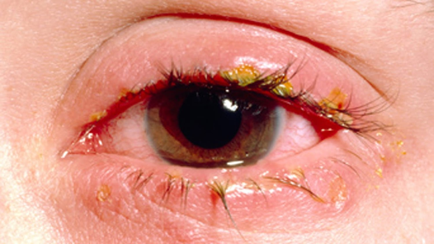 Eye Infections in Baby, Children & Adults - Causes, Diagnosis & Treatment
