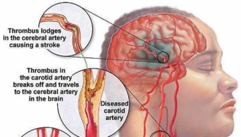 Carotid-Artery-Disease