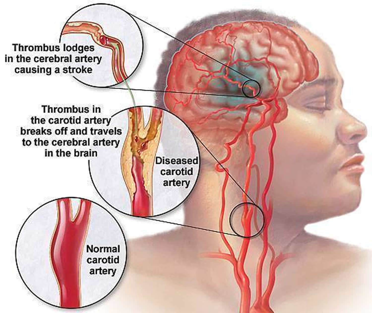 tobacco smoke removal disease Stenosis, Artery Dissection Carotid artery Carotid