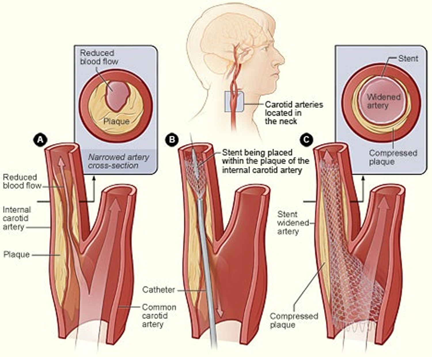 carotid-artery-disease-stenosis-carotid-artery-dissection