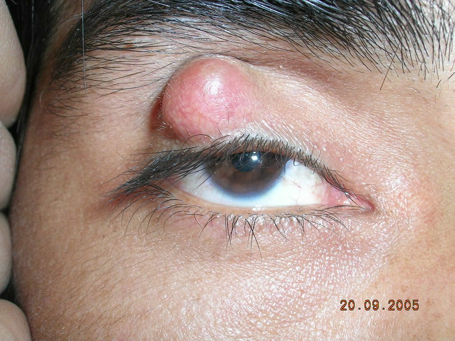 Chalazion