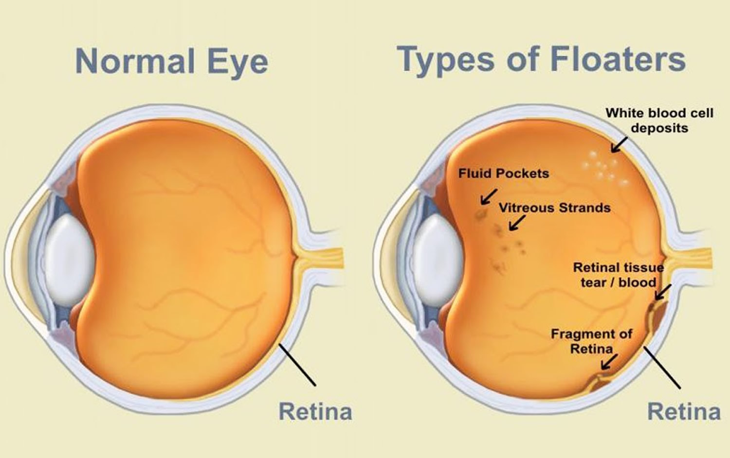 Eye Floaters, Black Eye Floaters and Eye Flashes - Causes and Treatment