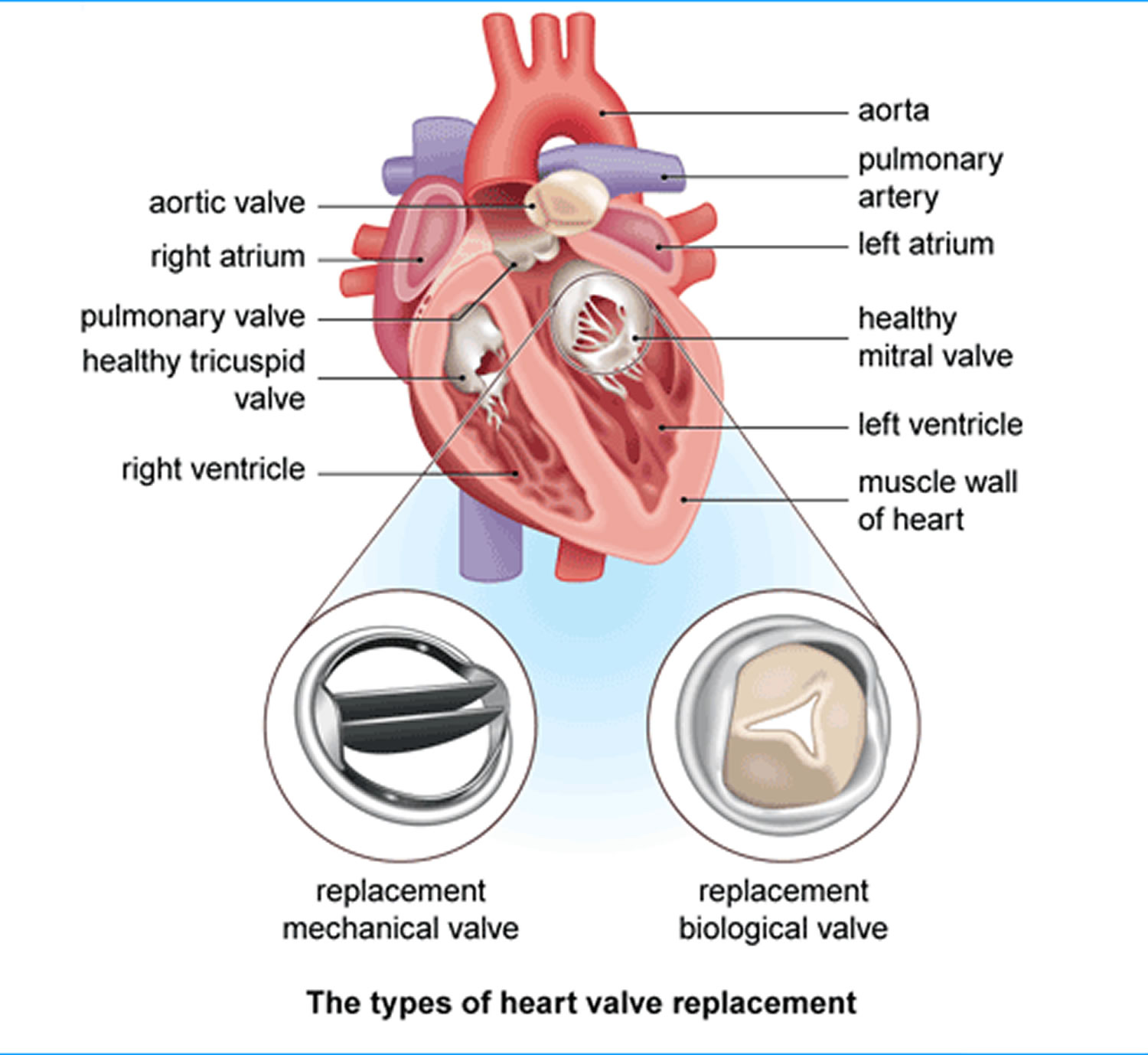 Heart Surgery Types - Open, Bypass, Ablation, Heart Valve surgery