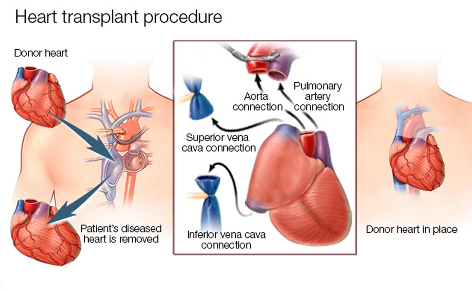 Santana Heart Procedure