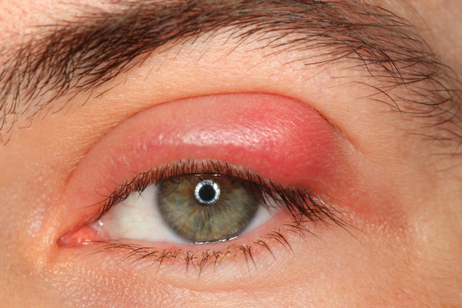 Hordeolum-stye-eye-infection