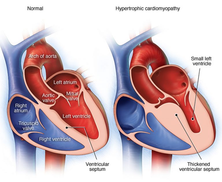 Heart Pain & Sharp Heart Pain - Causes, Symptoms, Treatment