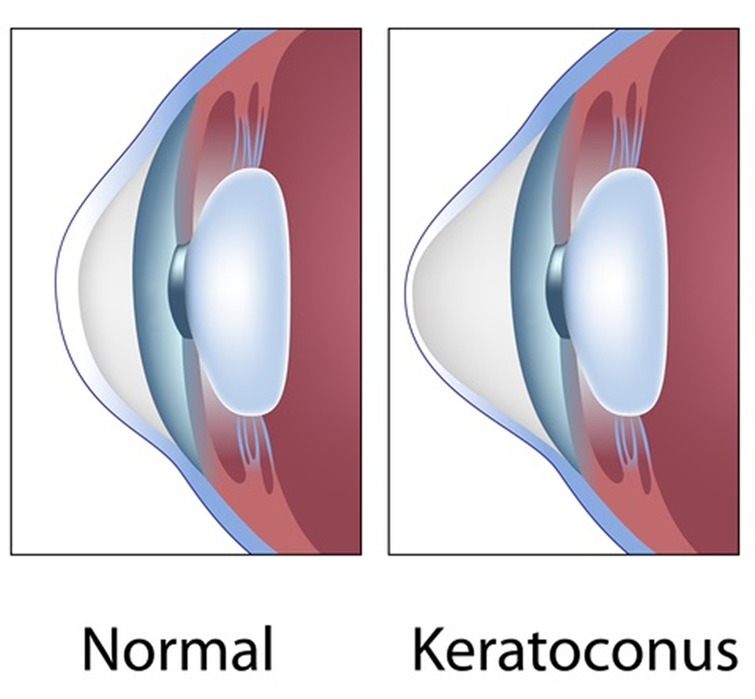 Keratoconus