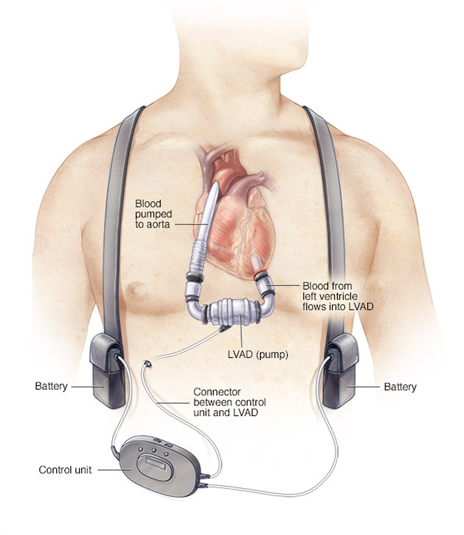 Left ventricular assist device