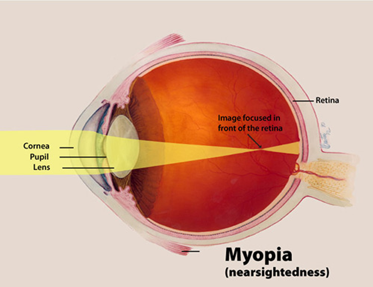 [diagram] Diagram Of Eye With Myopia Mydiagram Online