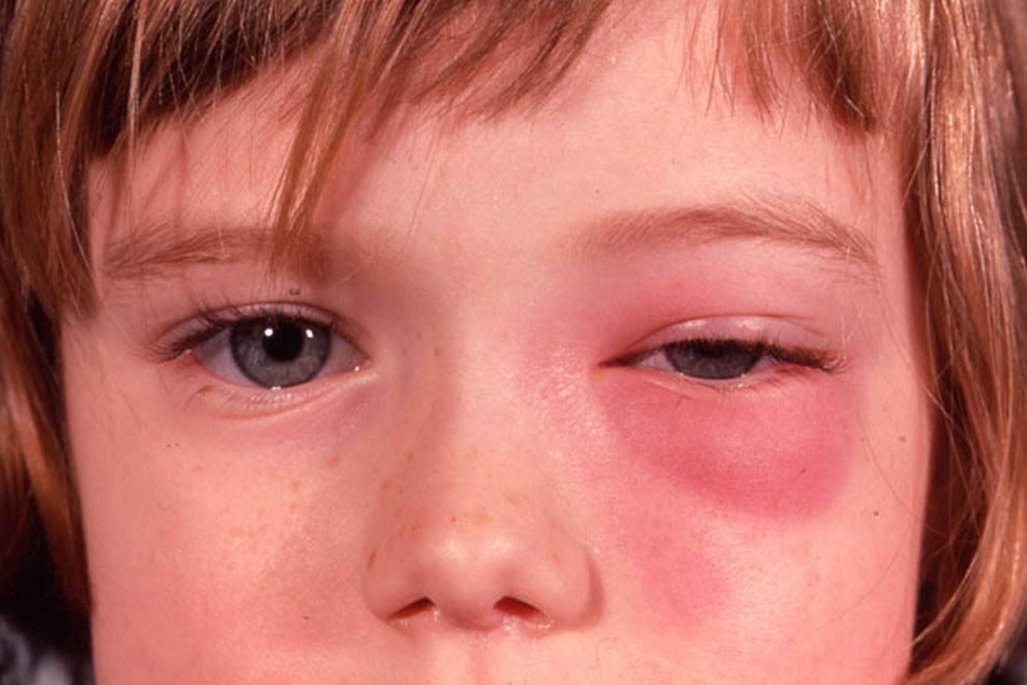 eye-infections-in-baby-children-adults-causes-diagnosis-treatment