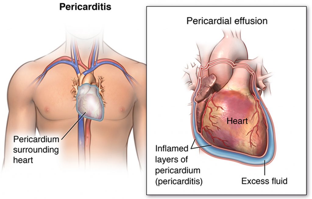 How To Differentiate Between Pain In The Esophagus And Heart Attack Pain