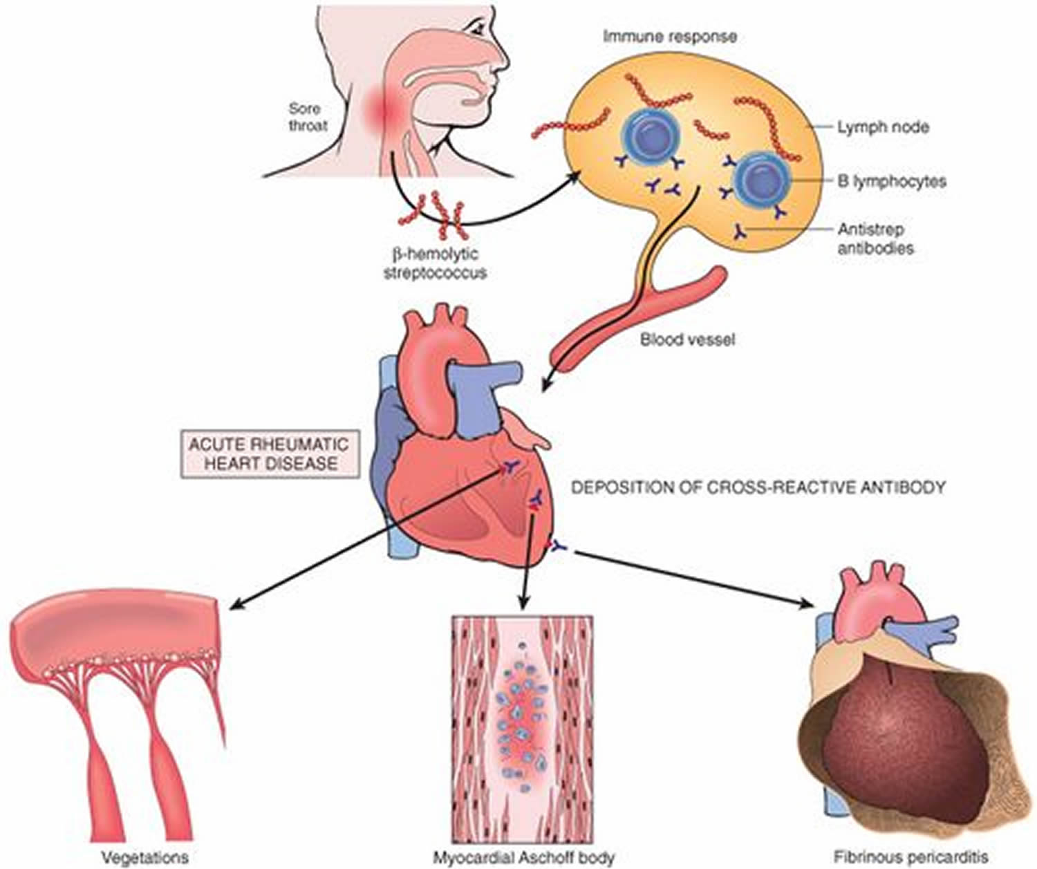 Rheumatic Heart Disease - Causes, Symptoms, Treatment & Prevention