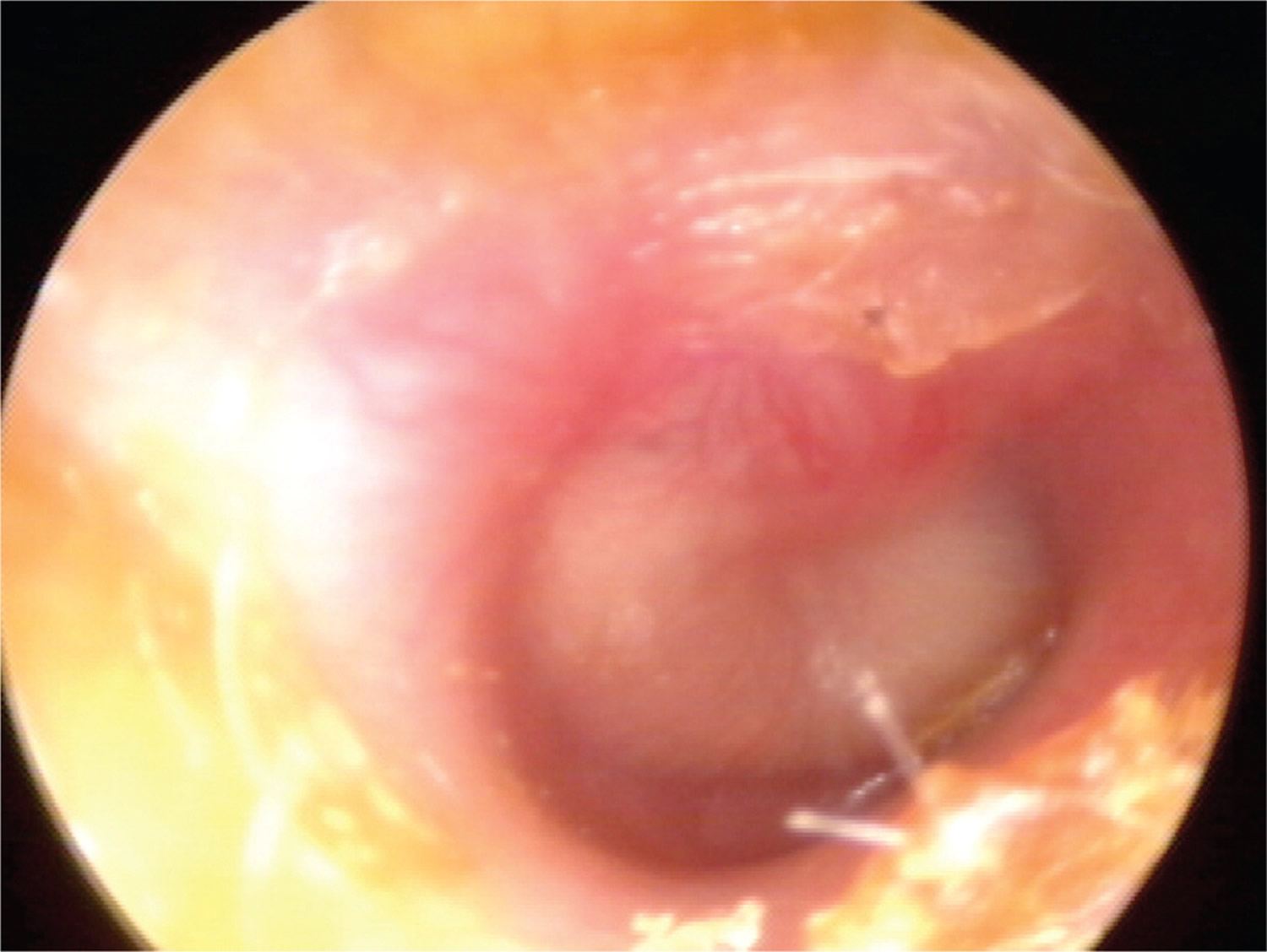 acute middle ear infection