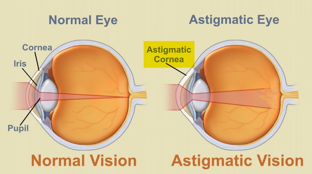 What is Astigmatism Causes, Symptoms,Treatment