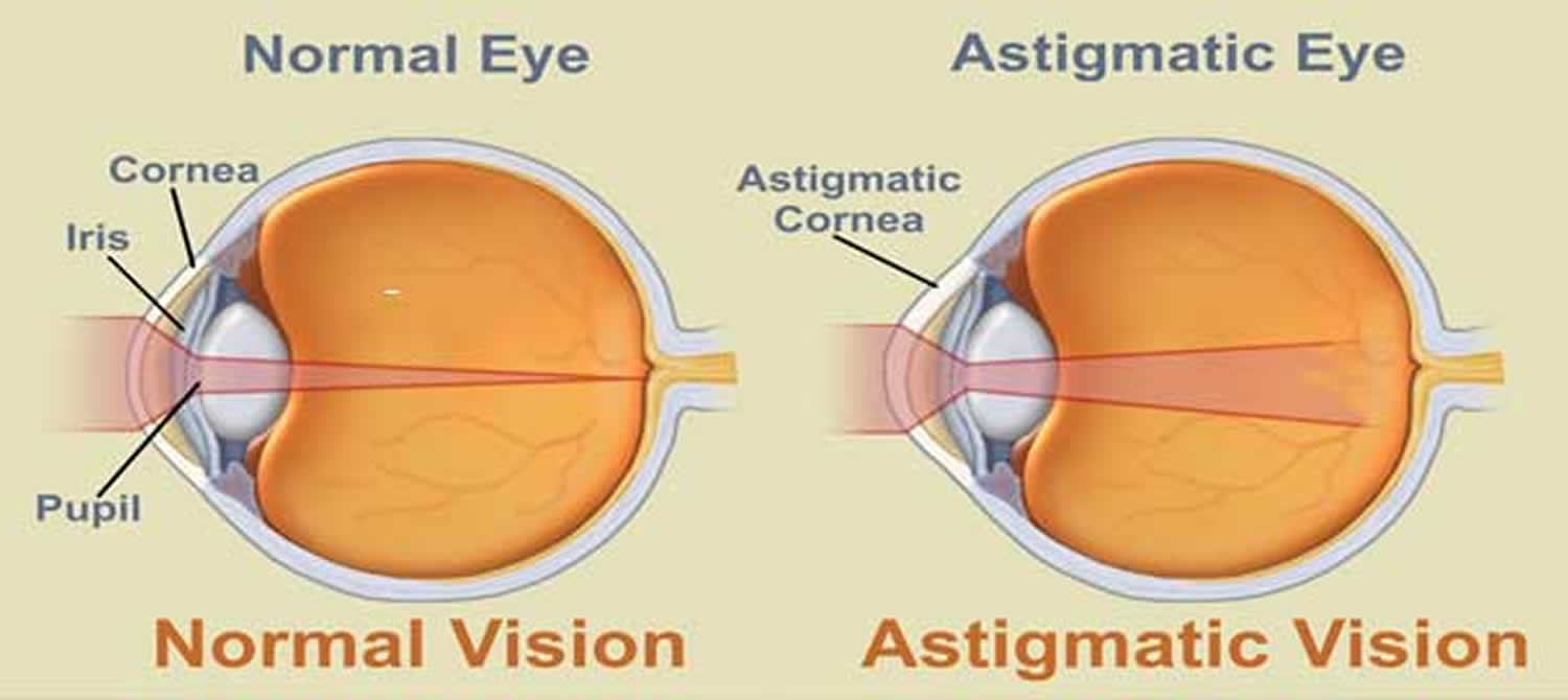 What Is Astigmatism Causes Symptoms Treatment