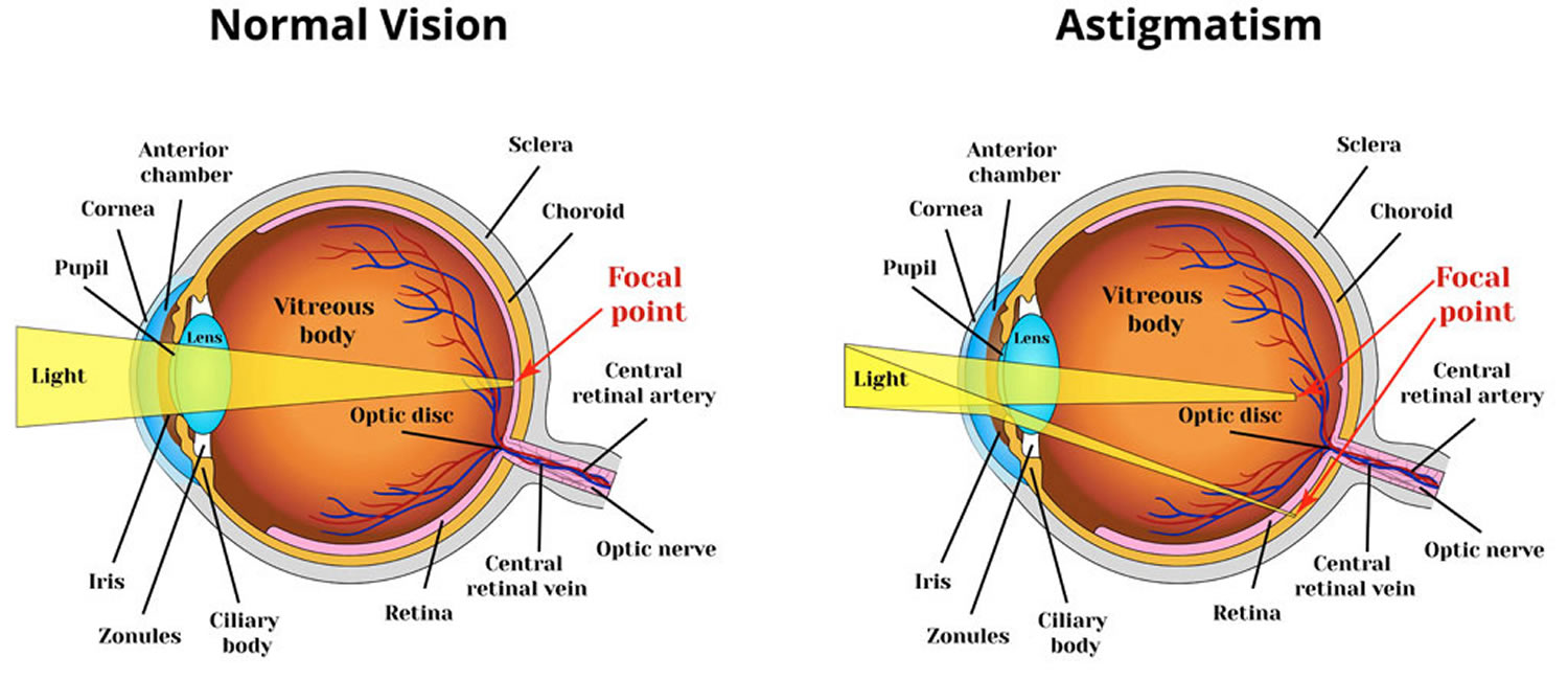 what-is-astigmatism-causes-symptoms-treatment