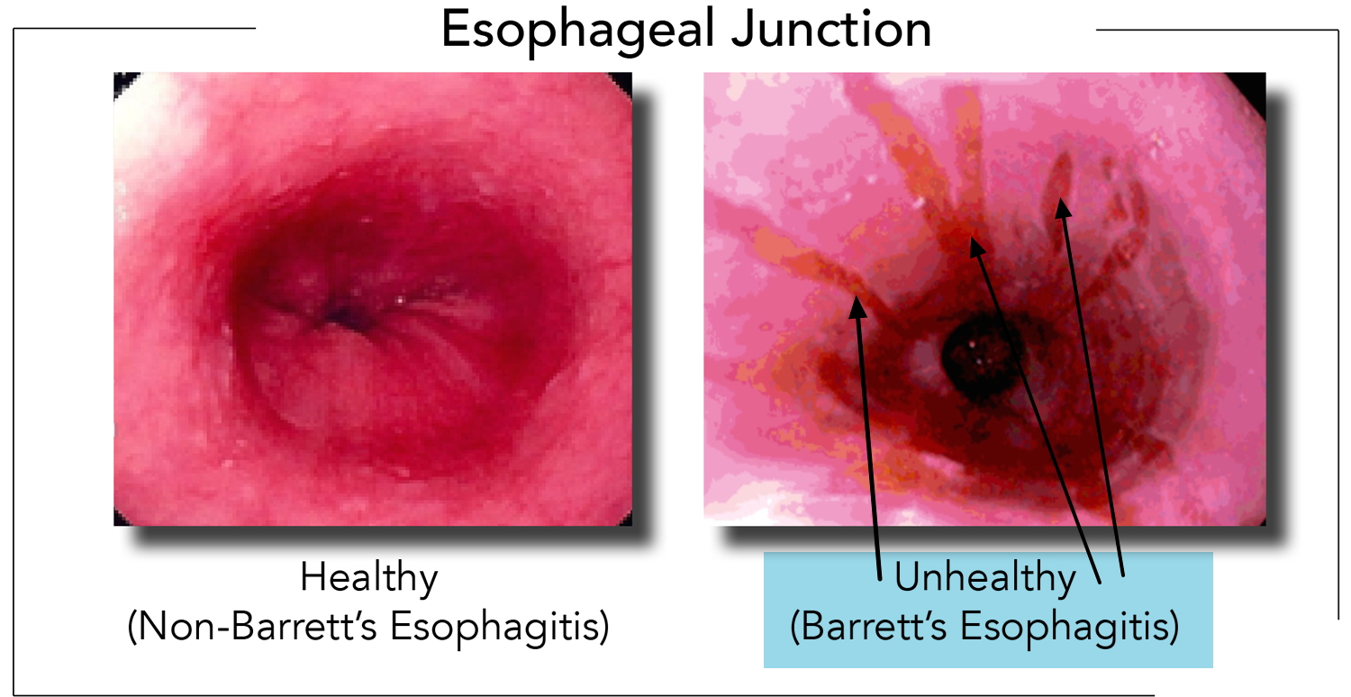 barrett's esophagus endoscopic view