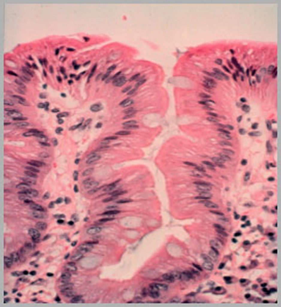 what-is-barrett-s-esophagus-causes-symptoms-diagnosis-treatments