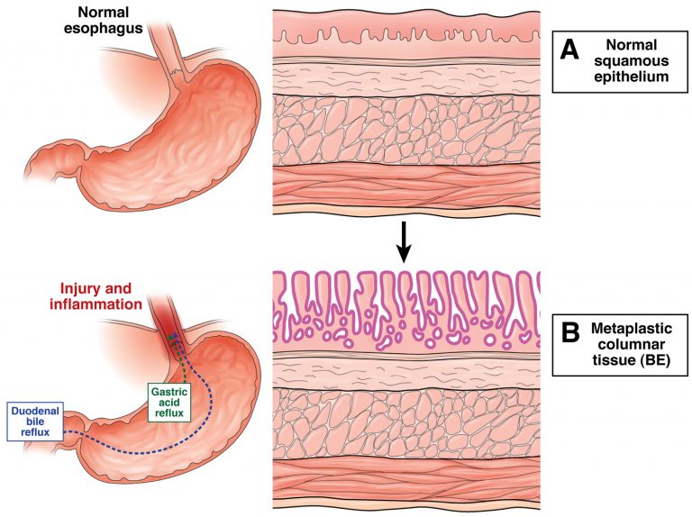 What Is Barretts Esophagus Causes Symptoms Diagnosis Treatments