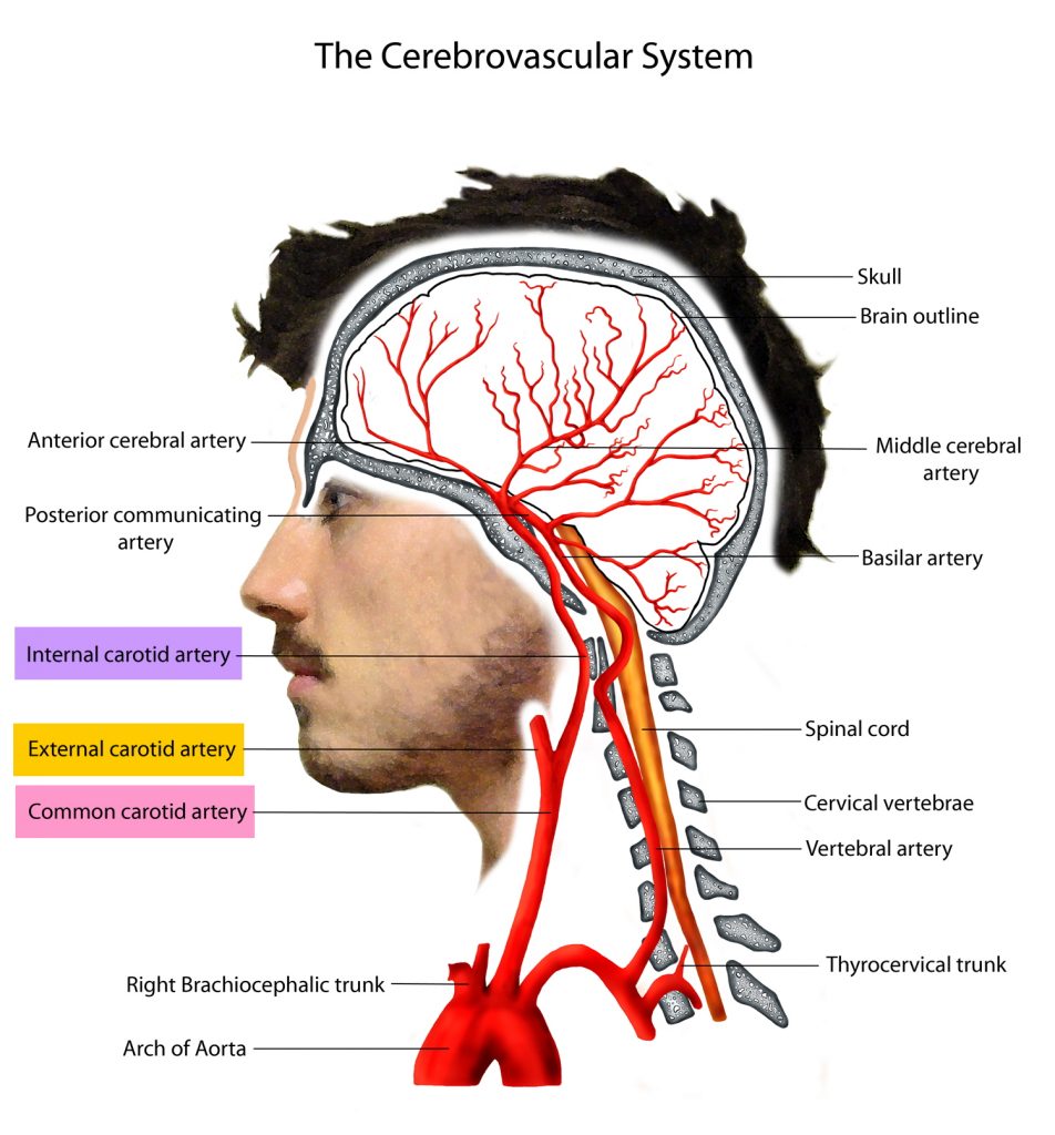 Carotid Artery Disease Stenosis Carotid Artery Dissection