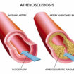 clogged arteries