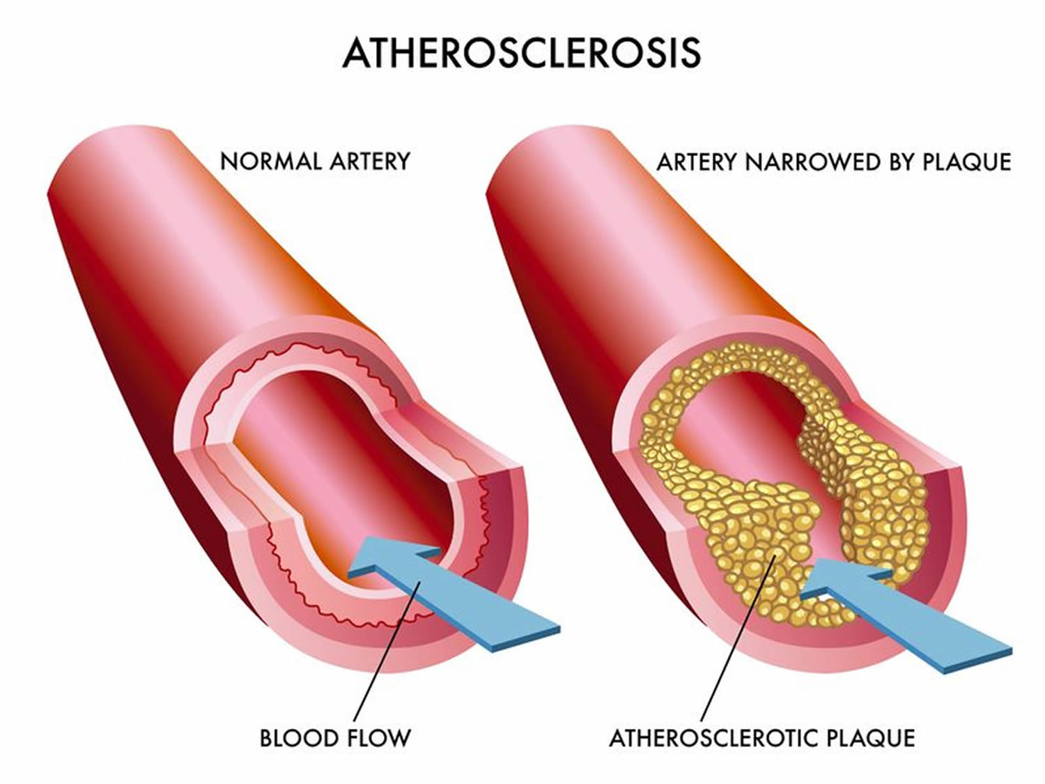 Is A Slow Heart Rate A Sign Of Clogged Arteries