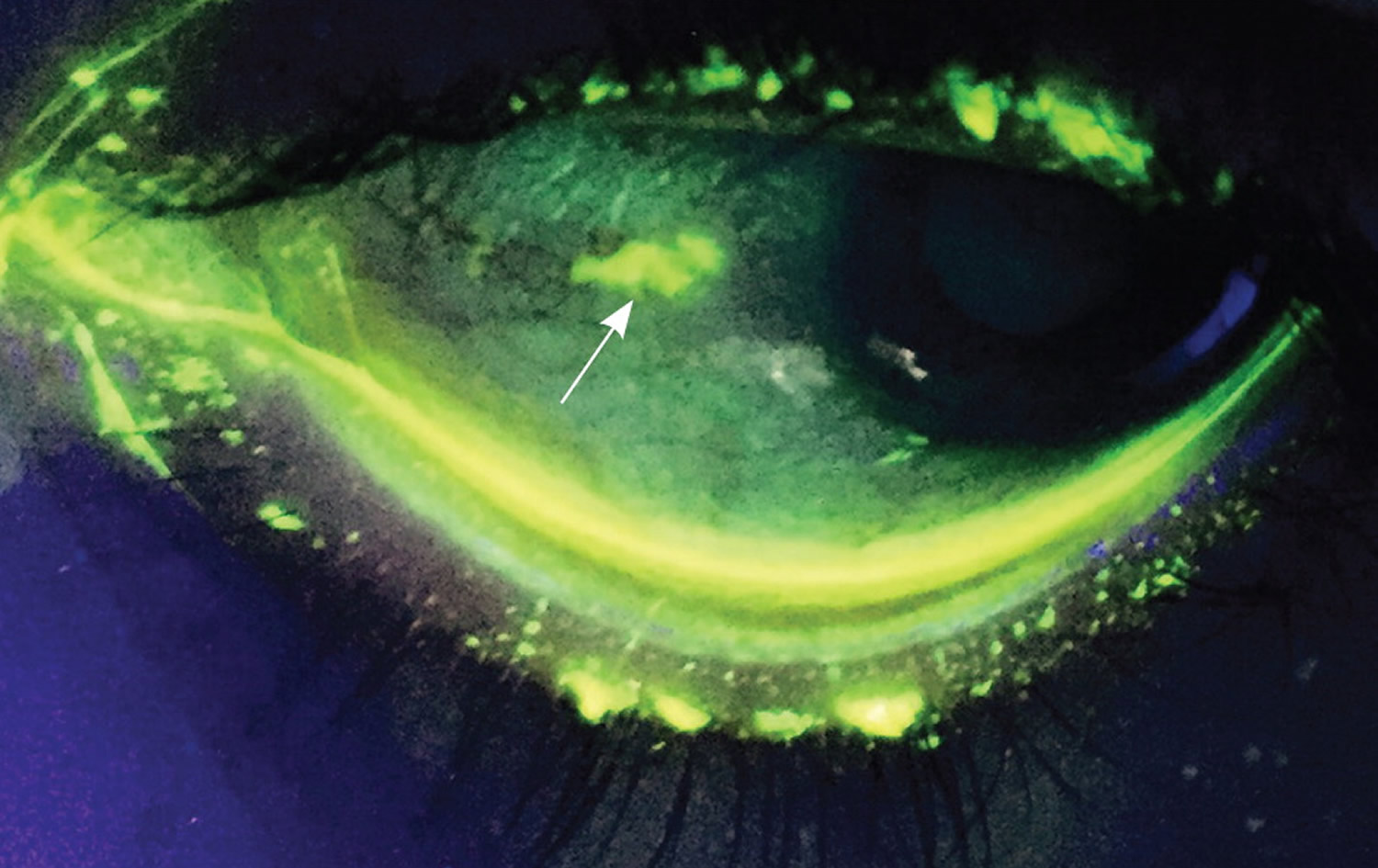 corneal abrasion visible under Wood lamp illumination