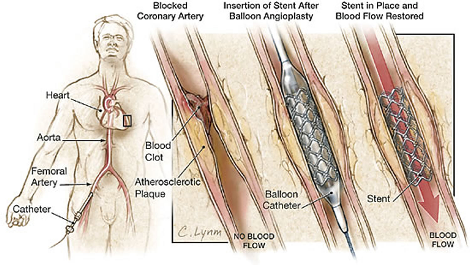 heart stent surgery