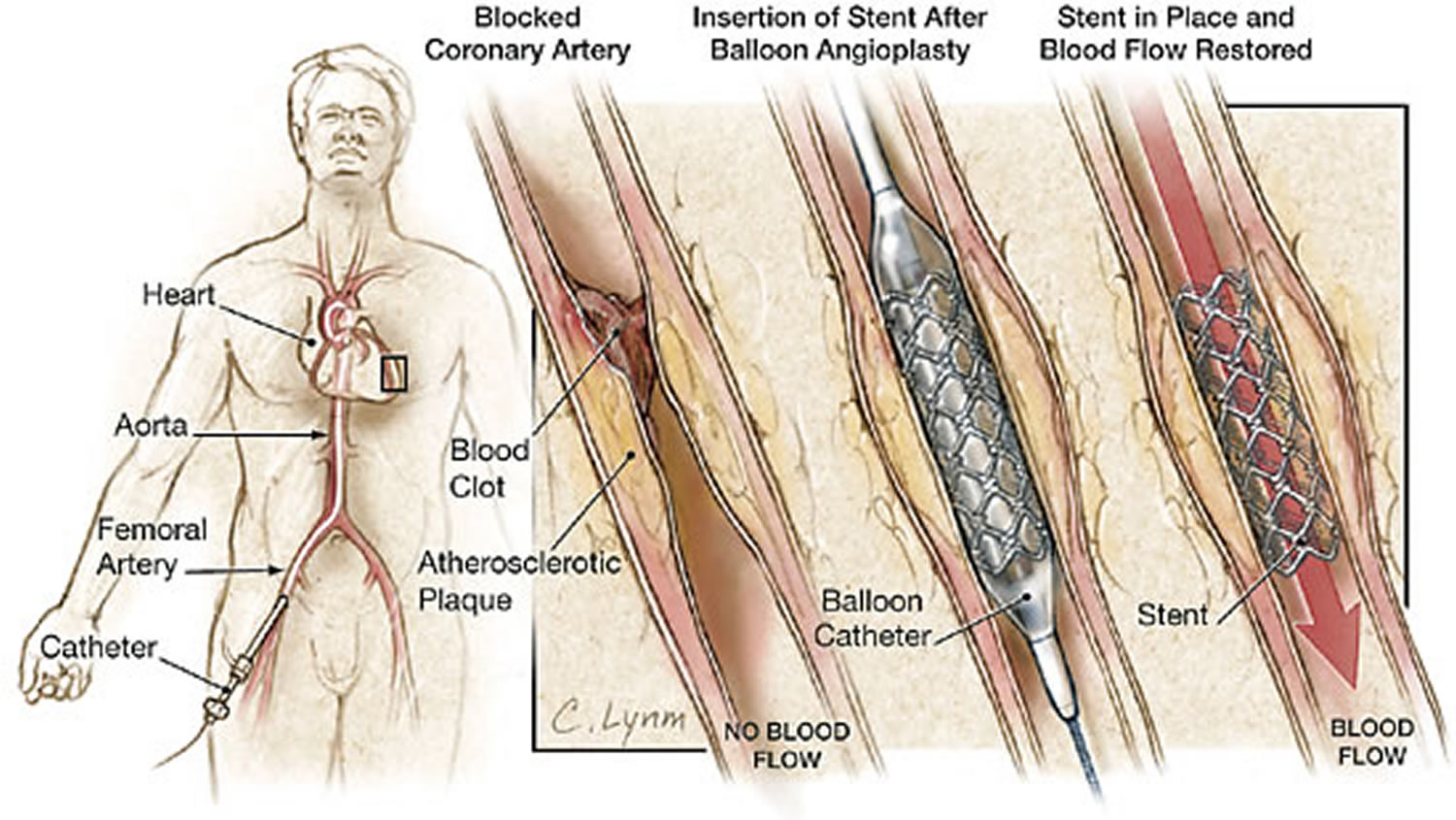 Stent in heart surgery