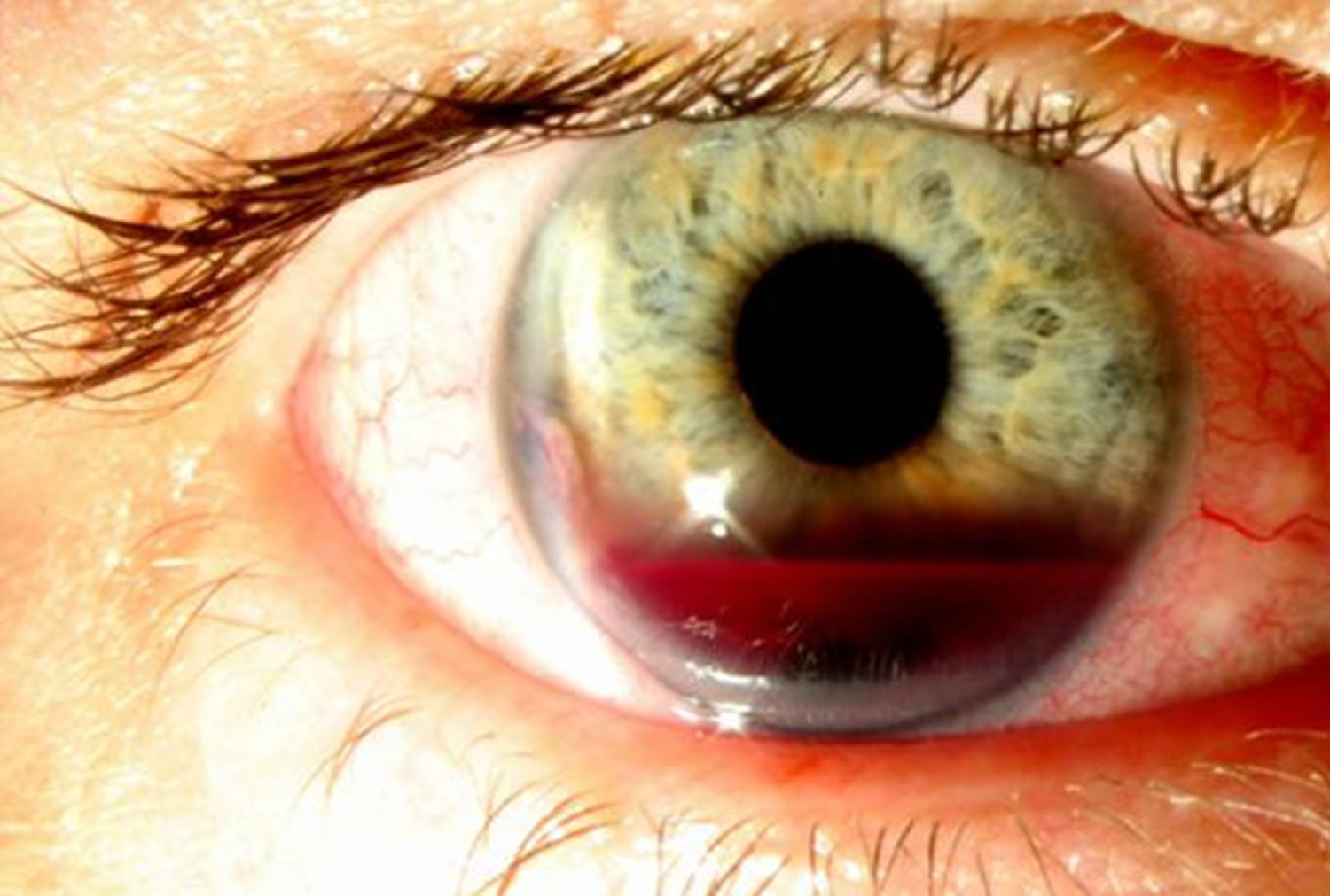 hyphema