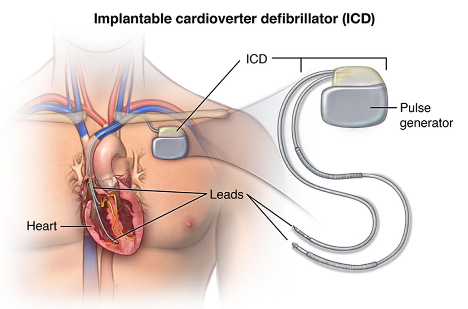 implantable cardioverter defibrillator