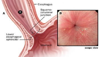 lower esophageal sphincter view